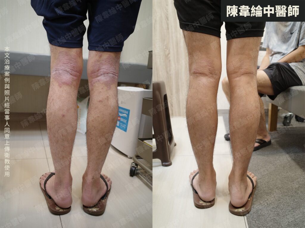 皮膚治療對照 01