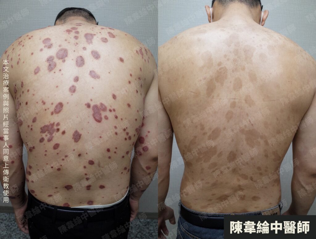 皮膚治療對照 02