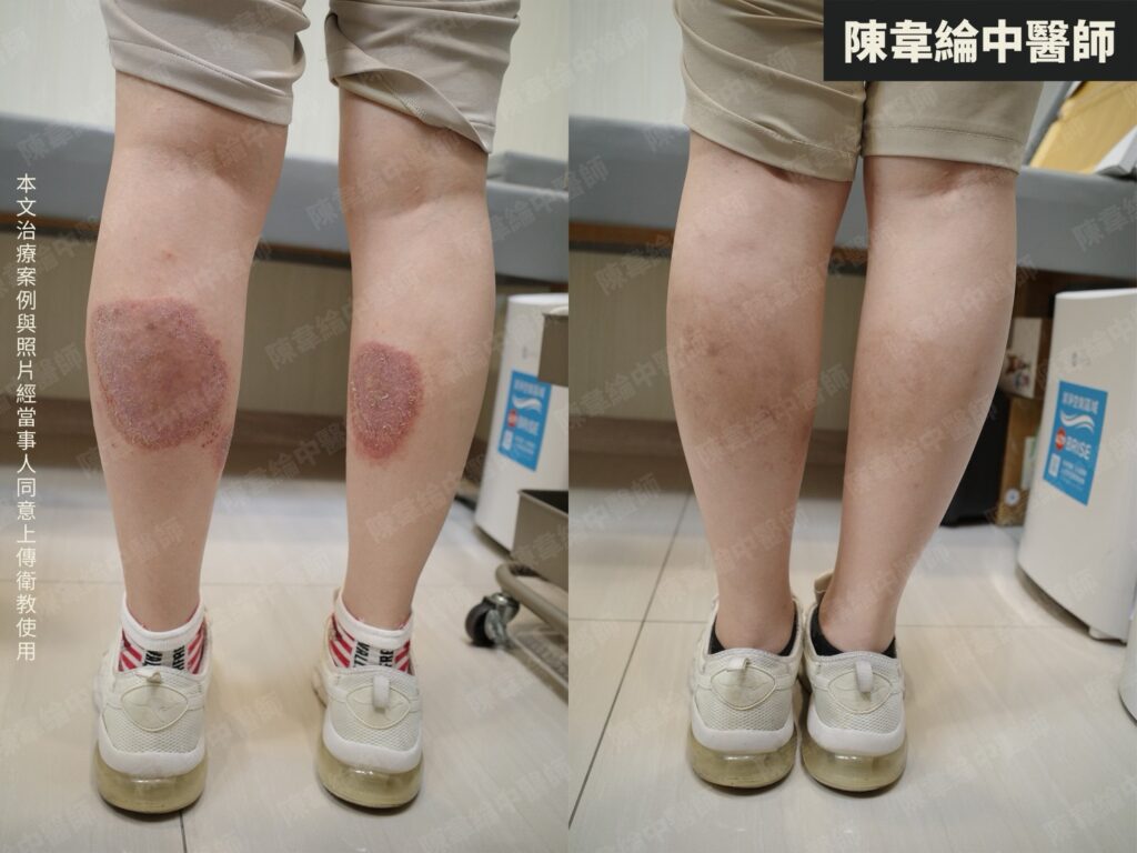 皮膚治療對照 03
